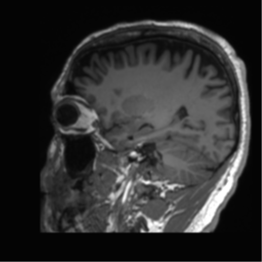 Normal brain MRI (non-focal epilepsy protocol) (Radiopaedia 53917-60040 Sagittal T1 47).png