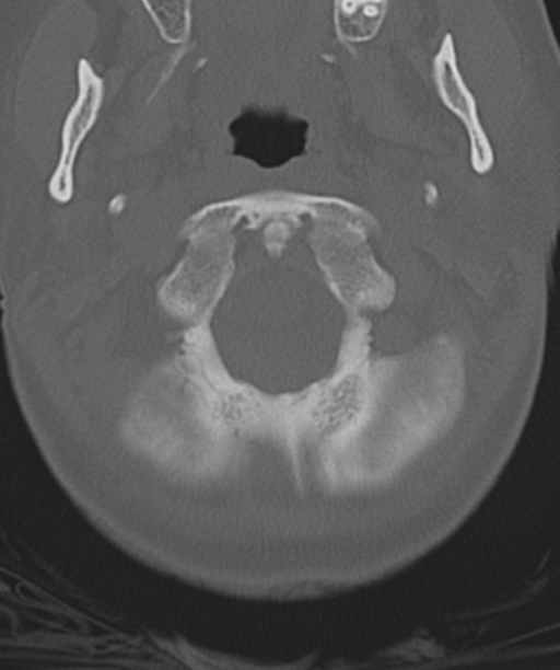 Normal cervical spine MRI (including Dixon) (Radiopaedia 42762-45926 Axial bone window 9).png