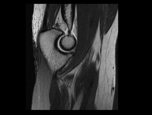 File:Normal elbow arthrograms (Radiopaedia 75550-86805 Sagittal PD 24).jpg