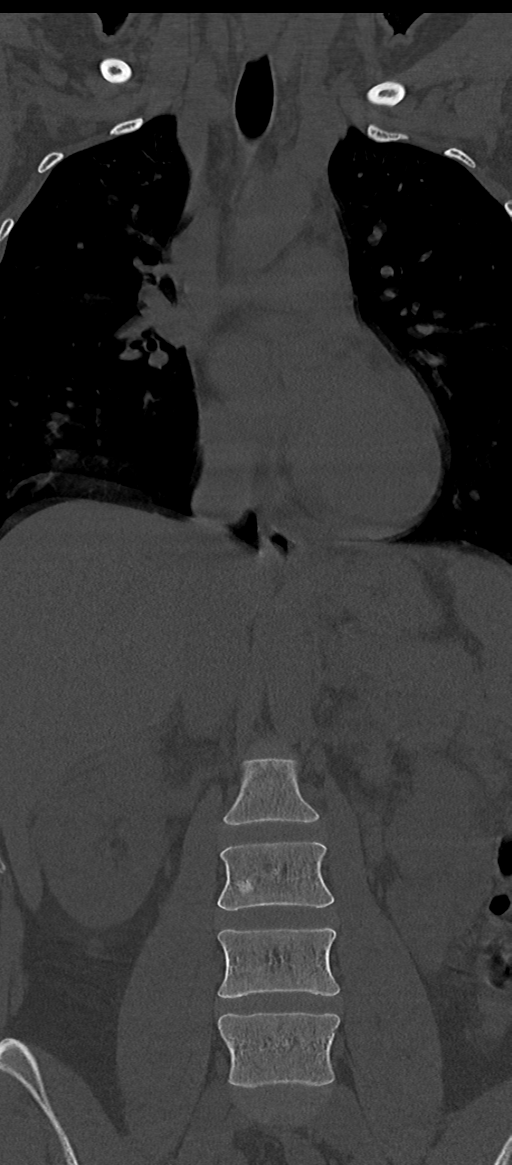 Normal thoracolumbar spine (Radiopaedia 43822-47309 Coronal bone window 31).png