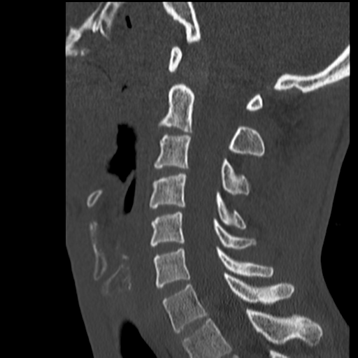 File:Normal trauma cervical spine (Radiopaedia 41017-43760 Sagittal bone window 26).png