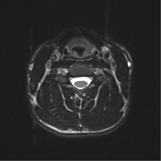 Normal trauma cervical spine (Radiopaedia 41017-43762 D 25).png