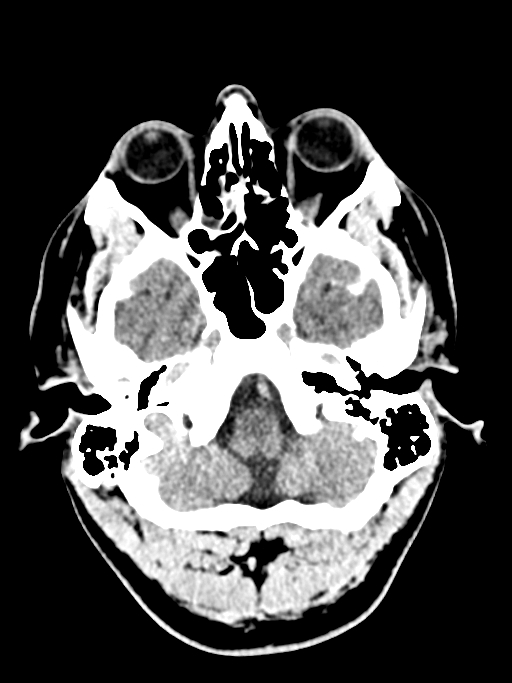 Normal trauma protocol brain and C-spine CT (Radiopaedia 83302-97709 Axial non-contrast 59).jpg