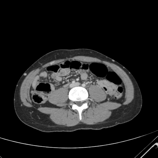File:Nutmeg liver- Budd-Chiari syndrome (Radiopaedia 46234-50635 B 43).png