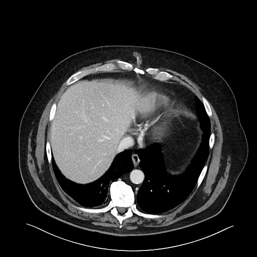 Obstructing sigmoid adenocarcinoma (Radiopaedia 58465-65619 A 23).jpg