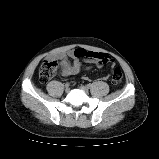 File:Obstructing ureteric calculus (Radiopaedia 18615-18514 Axial non-contrast 39).jpg