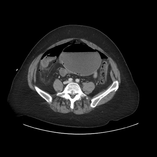 Obstructive distal colonic adenocarcinoma causing cecal perforation (Radiopaedia 86830-102989 A 132).jpg