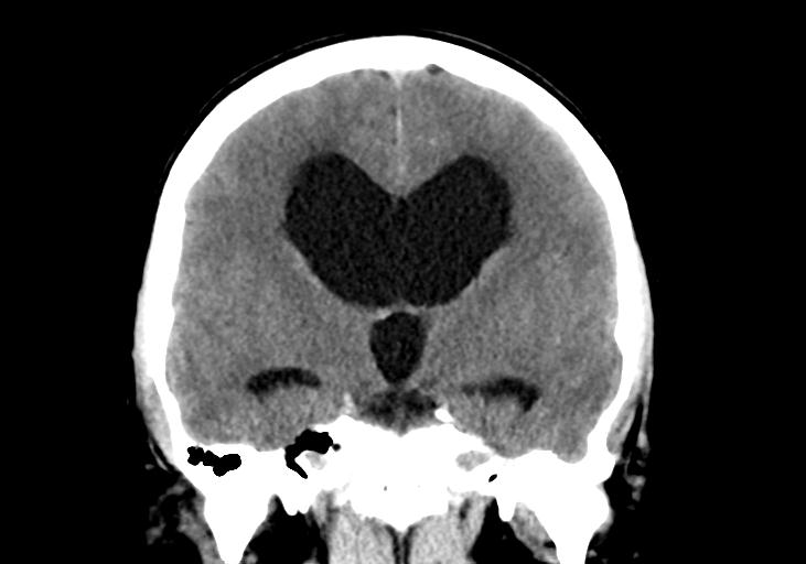 File:Obstructive hydrocephalus (Radiopaedia 30453-31119 Coronal non-contrast 19).jpg
