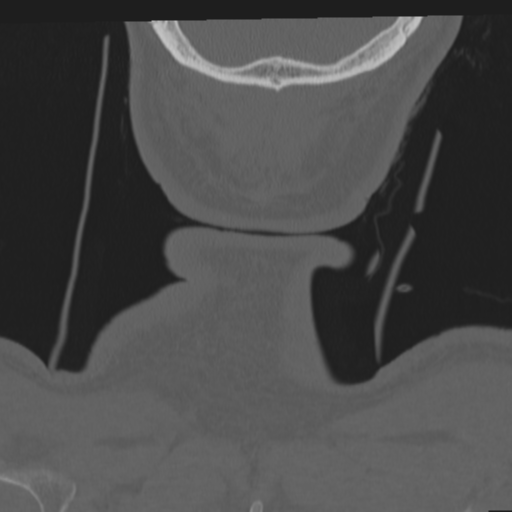 File:Occipital condyle fracture (Radiopaedia 33467-34517 Coronal bone window 79).png