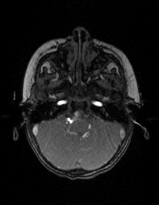 Occipital horn syndrome (Radiopaedia 14255-14129 MRA 30).jpg