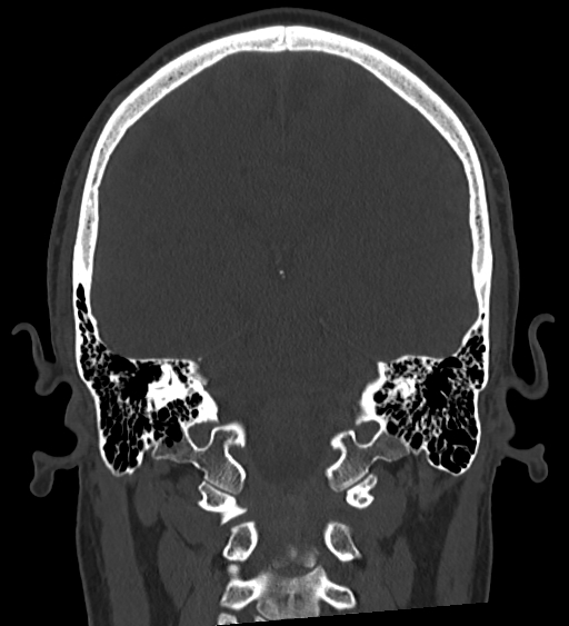Occipital spur and Currarino type A atlas anomaly (Radiopaedia 87027-103285 Coronal bone window 94).jpg