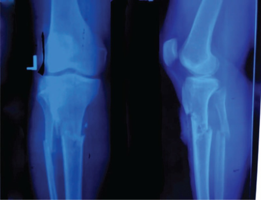 Knee showing tibial tuberosity avulsion fracture (and proximal tibial fracture)