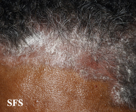 File:Psoriasis (Dermatology Atlas 47).jpg