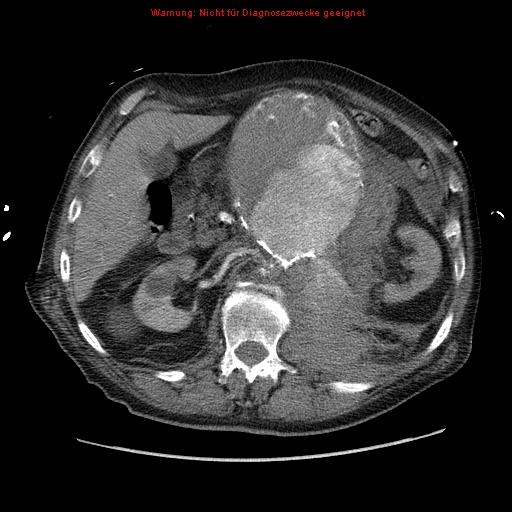 File:Abdominal aortic aneurysm- extremely large, ruptured (Radiopaedia 19882-19921 Axial C+ arterial phase 24).jpg