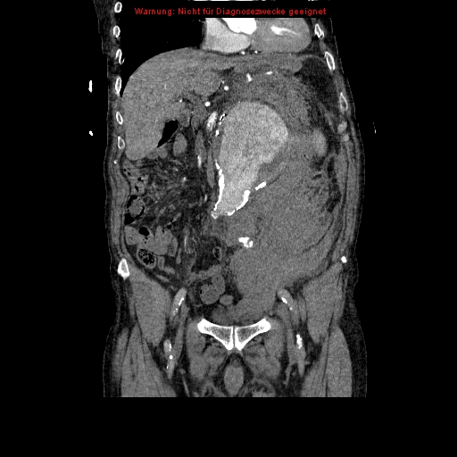 Abdominal aortic aneurysm- extremely large, ruptured (Radiopaedia 19882-19921 Coronal C+ arterial phase 44).jpg