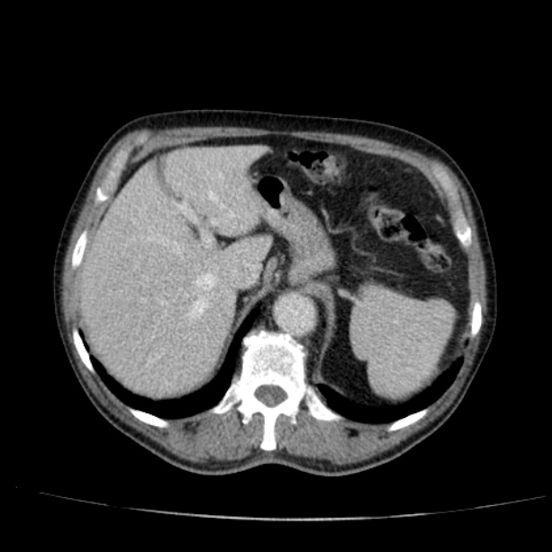 Abdominal aortic aneurysm (Radiopaedia 29248-29660 Axial C+ portal venous phase 14).jpg