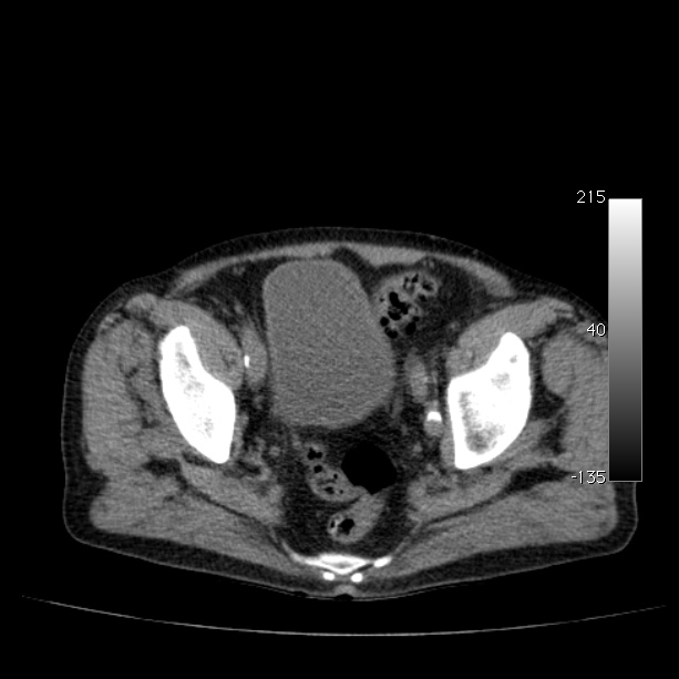 Abdominal aortic aneurysm (Radiopaedia 29248-29660 Axial non-contrast 50).jpg