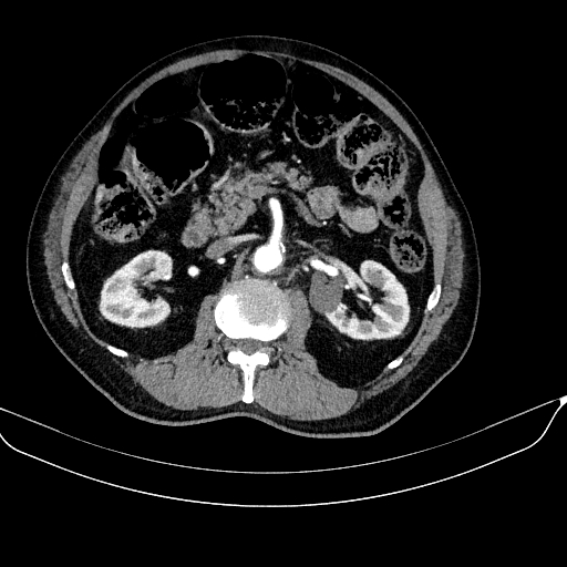 File:Abdominal aortic aneurysm (Radiopaedia 67117-76452 Axial C+ arterial phase 57).jpg