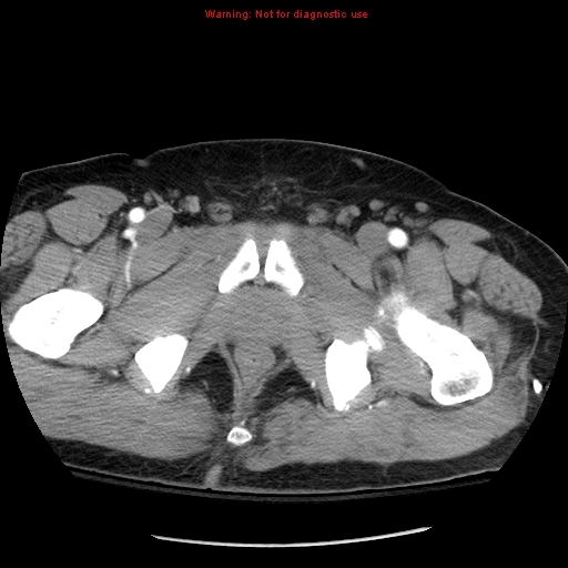 Abdominal aortic aneurysm (Radiopaedia 8190-9038 Axial C+ arterial phase 86).jpg