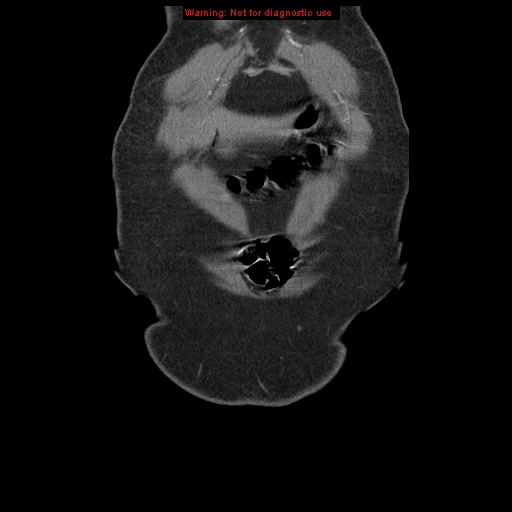 Abdominal aortic aneurysm (Radiopaedia 8190-9038 Coronal C+ arterial phase 9).jpg