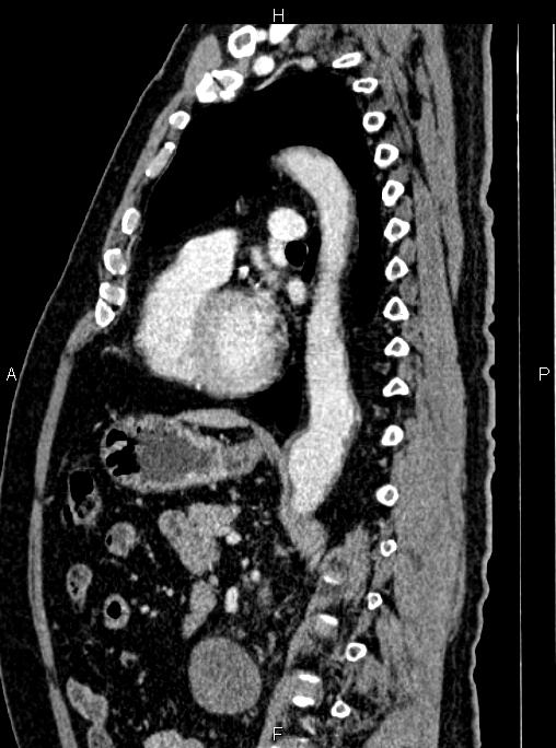 Abdominal aortic aneurysm (Radiopaedia 83094-97462 Sagittal renal cortical phase 75).jpg