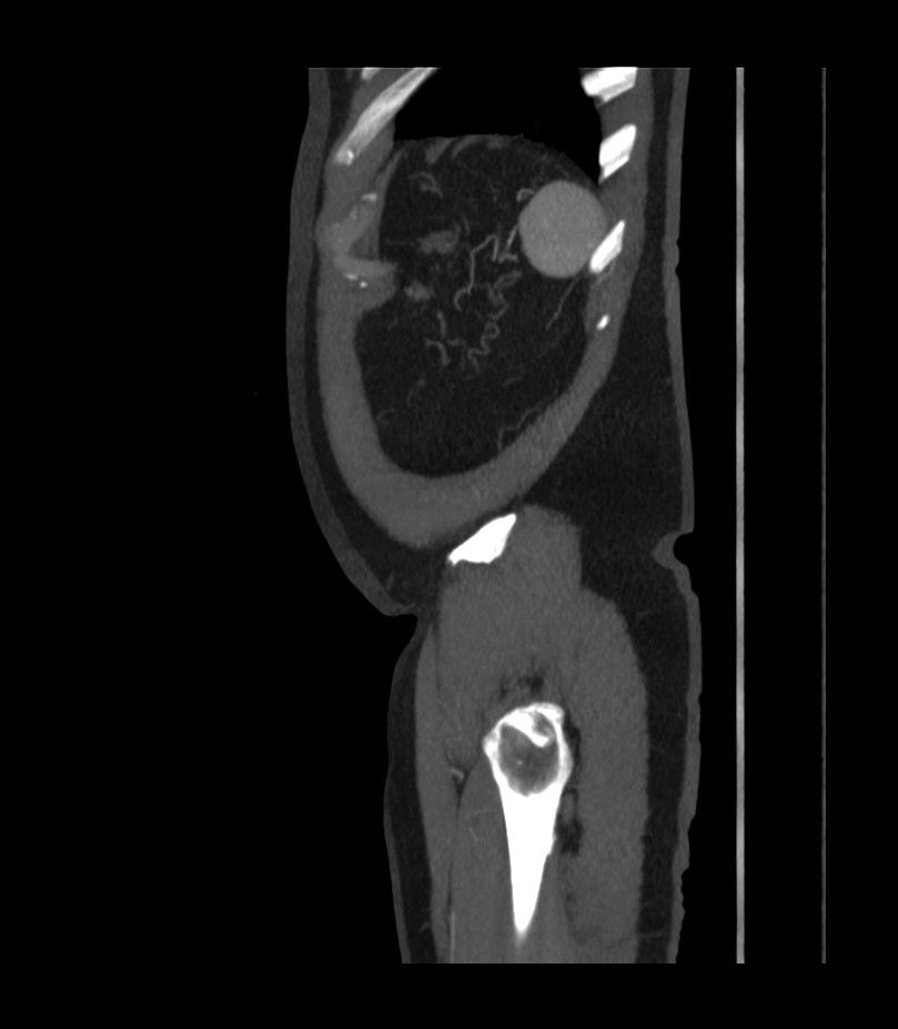 Abdominal aortic aneurysm with thrombus fissuration (Radiopaedia 46218-50618 Sagittal C+ arterial phase 54).jpg