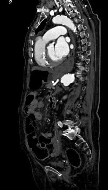 Abdominal aortic aneurysm with thrombus fissuration (Radiopaedia 73192-83919 Sagittal C+ arterial phase 56).jpg
