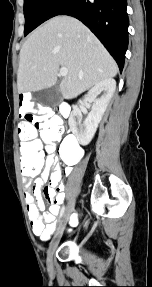 Abdominal wall and retroperitoneal tuberculosis (Radiopaedia 88137-104729 Sagittal C+ portal venous phase 100).jpg