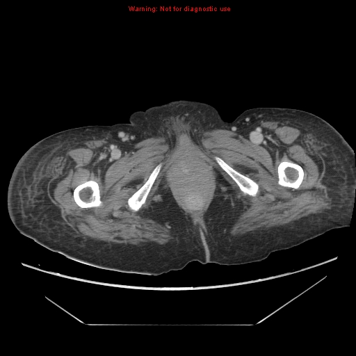 File:Abdominal wall hematoma (Radiopaedia 9427-10112 Axial C+ portal venous phase 116).jpg