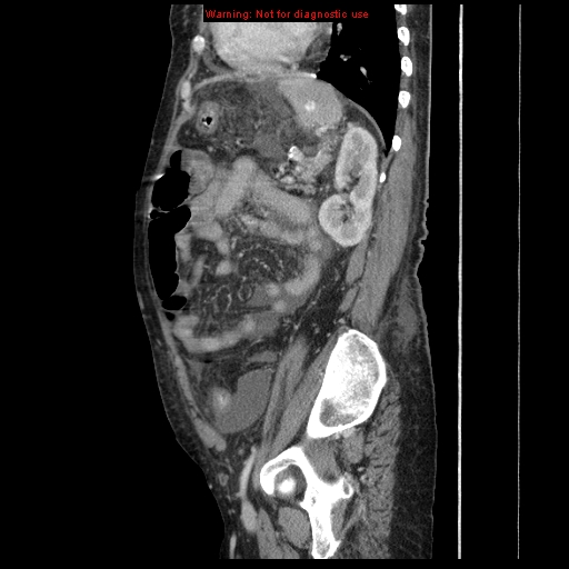 Abdominal wall hematoma (Radiopaedia 9427-10112 Sagittal C+ portal venous phase 32).jpg