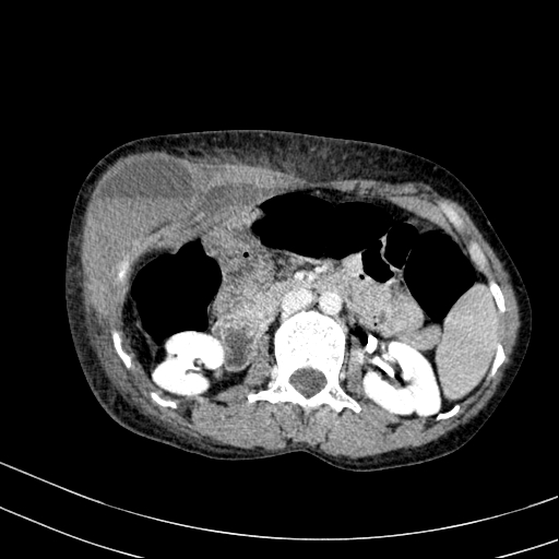 File:Abdominal wall hematoma with active bleeding (Radiopaedia 83915-99117 Axial C+ portal venous phase 27).jpg