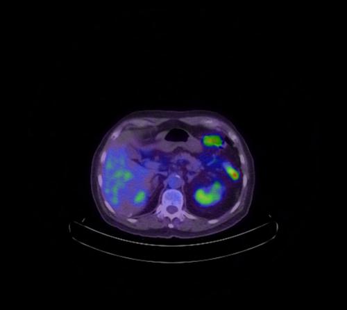 Abdominal wall metastasis from colorectal carcinoma (Radiopaedia 31016-31719 Axial 81).jpg