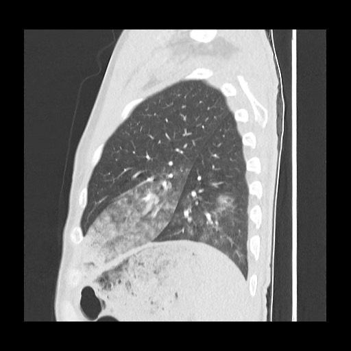 Accessory left horizontal fissure with lingular pneumonia (Radiopaedia 53763-59843 Sagittal lung window 54).jpg