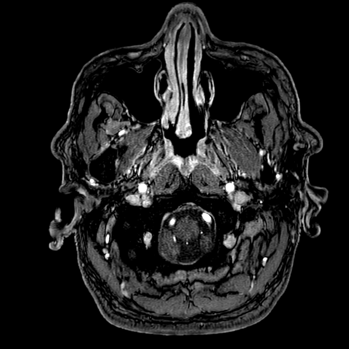 Accessory middle cerebral artery (Radiopaedia 73114-83828 Axial MRA 1).jpg