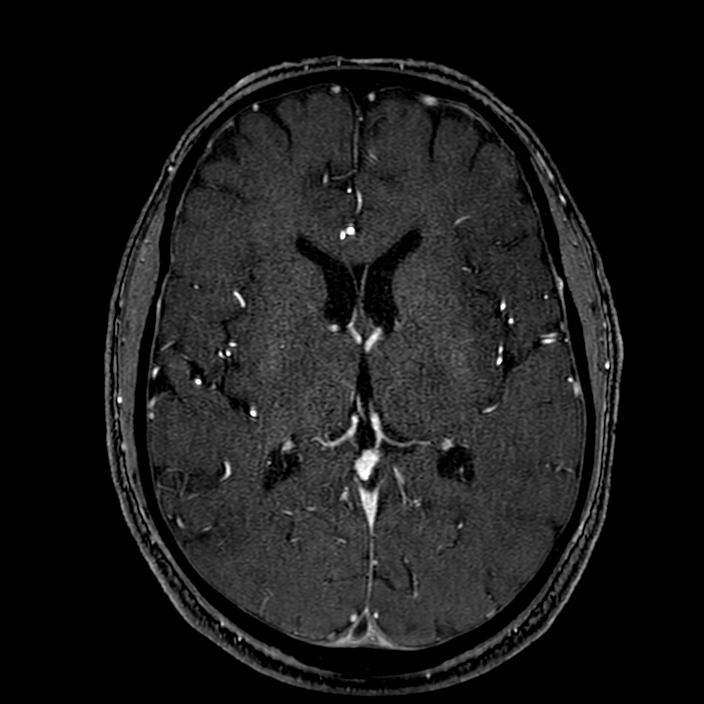 Accessory middle cerebral artery (Radiopaedia 73114-83828 Axial MRA 112).jpg