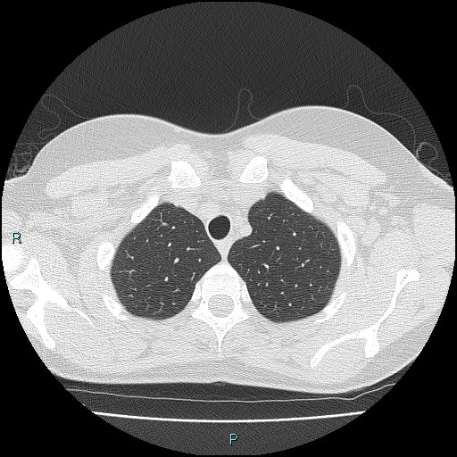 Accidental foreign body aspiration (seamstress needle) (Radiopaedia 77740-89983 Axial lung window 11).jpg