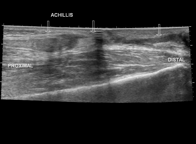File:Achilles tendon tear (Radiopaedia 18551-18421 Longitudinal 1).jpg