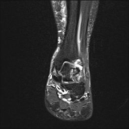 File:Achilles tendon tear (Radiopaedia 77615-89819 Coronal STIR 14).jpg