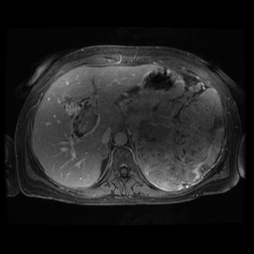 Acinar cell carcinoma of the pancreas (Radiopaedia 75442-86668 Axial T1 C+ fat sat 94).jpg