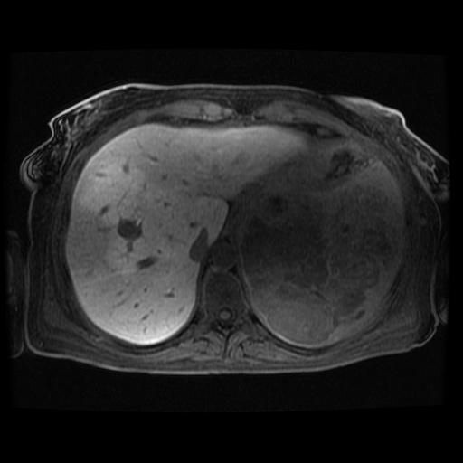 Acinar cell carcinoma of the pancreas (Radiopaedia 75442-86668 Axial late phase (~30 mins) 110).jpg