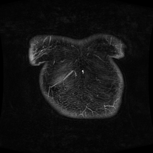 Acinar cell carcinoma of the pancreas (Radiopaedia 75442-86668 Coronal T1 C+ fat sat 183).jpg