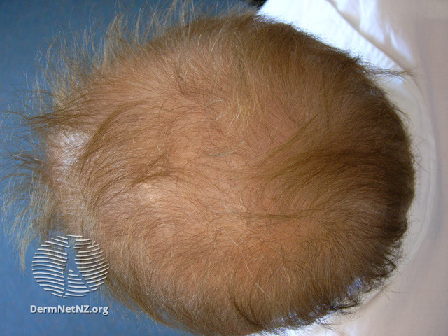 File:Acitretin diffuse hair loss (DermNet NZ treatments-acitretin-hairloss-1).jpg