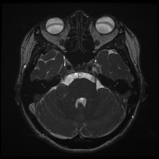 Acoustic neuroma (Radiopaedia 34049-35283 Axial 65).png