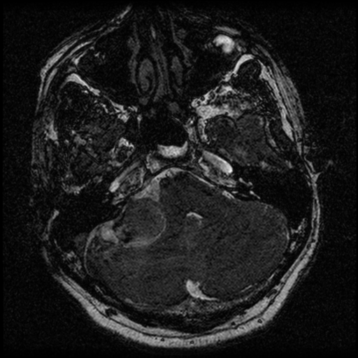 File:Acoustic schwannoma (Radiopaedia 39170-41387 Axial FIESTA 57).png