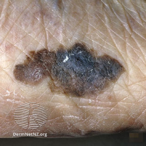 File:Acral lentignous melanoma (DermNet NZ lesions-melanoma-s-alm6).jpg