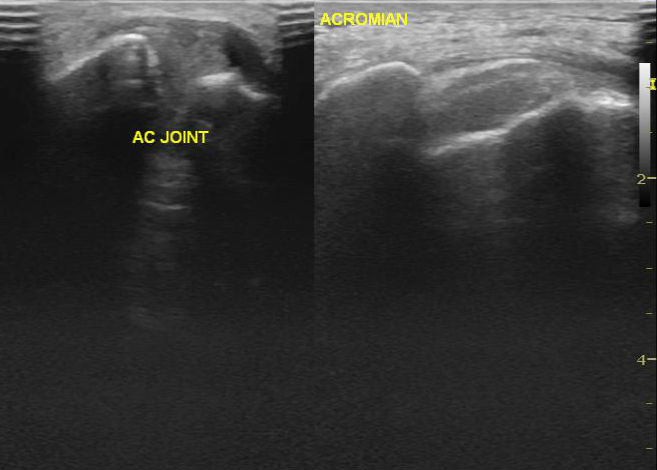 File:Acromial fracture - ultrasound (Radiopaedia 26729-26891 B 1).jpg