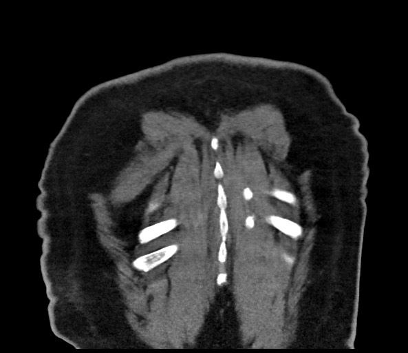 Acromioclavicular joint cyst (Radiopaedia 58455-65610 Coronal C+ arterial phase 132).jpg