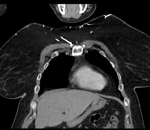 Acromioclavicular joint cyst (Radiopaedia 58455-65610 Coronal C+ arterial phase 41).jpg