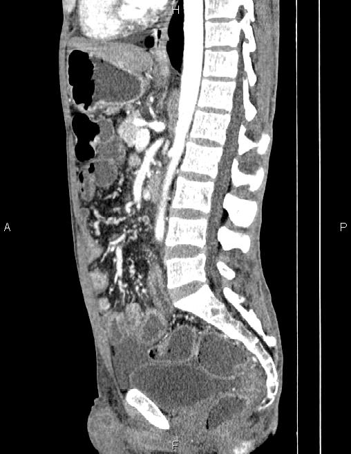 Active crohn disease (Radiopaedia 87133-103397 Sagittal C+ arterial phase 47).jpg