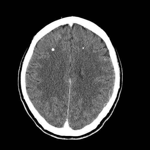 File:Active neurocysticercosis before and after therapy (Radiopaedia 71710-82099 Axial C+ delayed 35).jpg